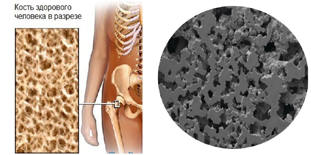 镍化钛的多孔结构类似于活组织的海绵状骨小梁